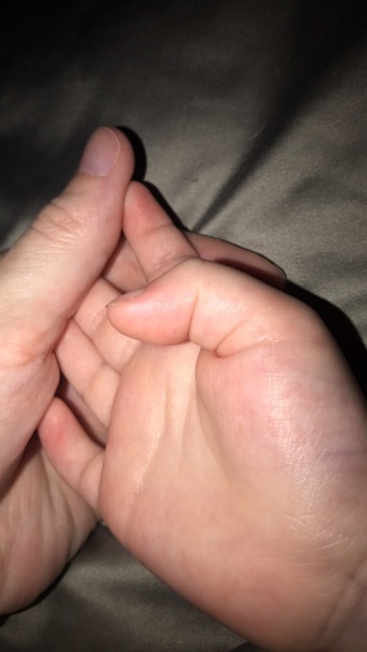 Trigger thumb