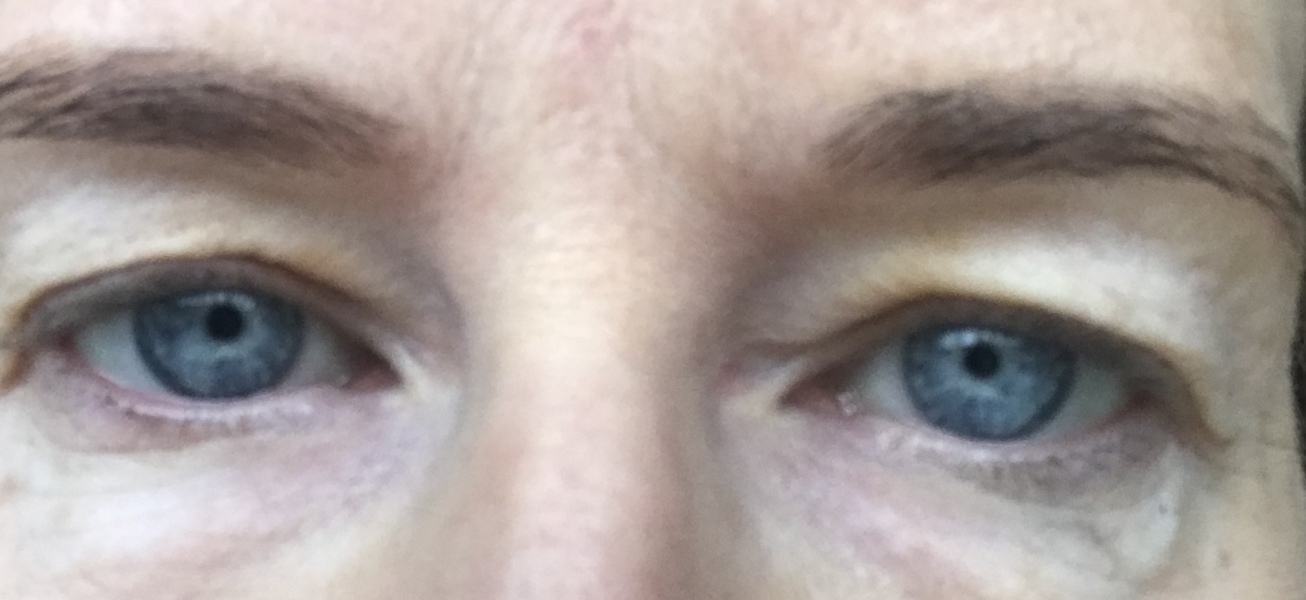 Upper Blepheroplasty