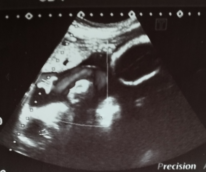 27 weeks fetus ultrasound... Guess gender prediction 