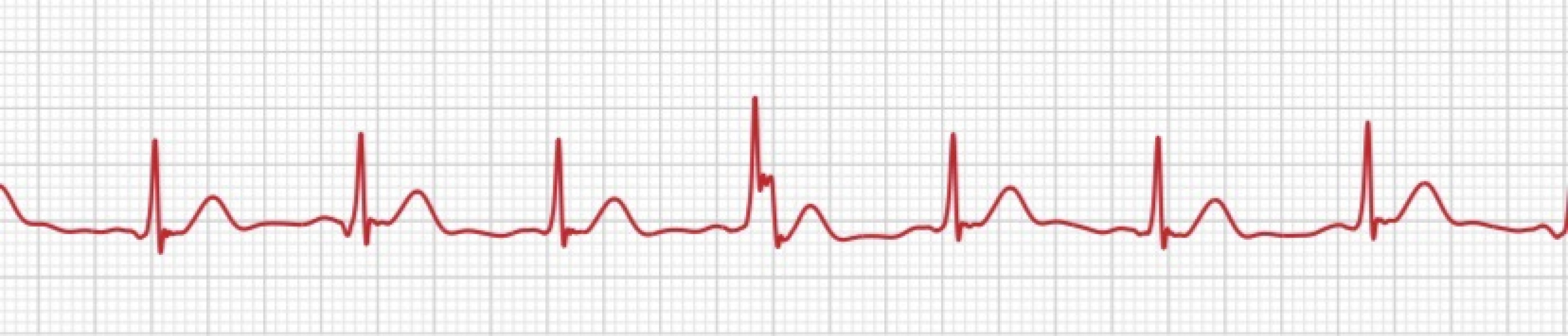 Any ECG/heart/cardio experts?