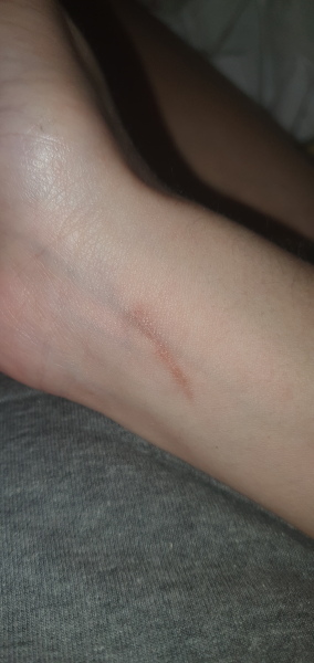 Cat scratched my son, will it scar?