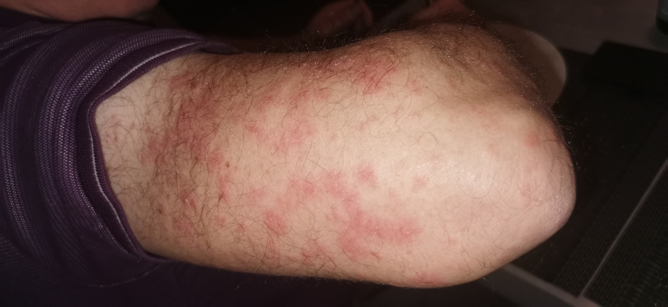 What is this rash? 
