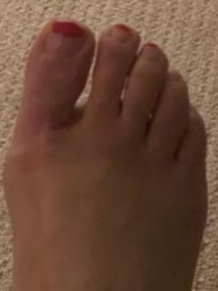 Show me a pic of your bunions…