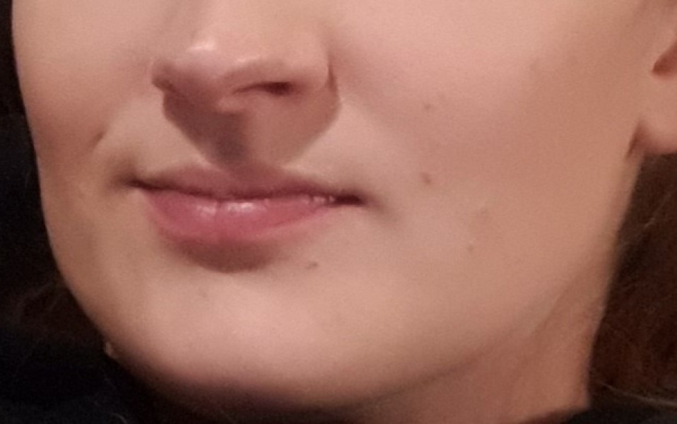 Mole removal 