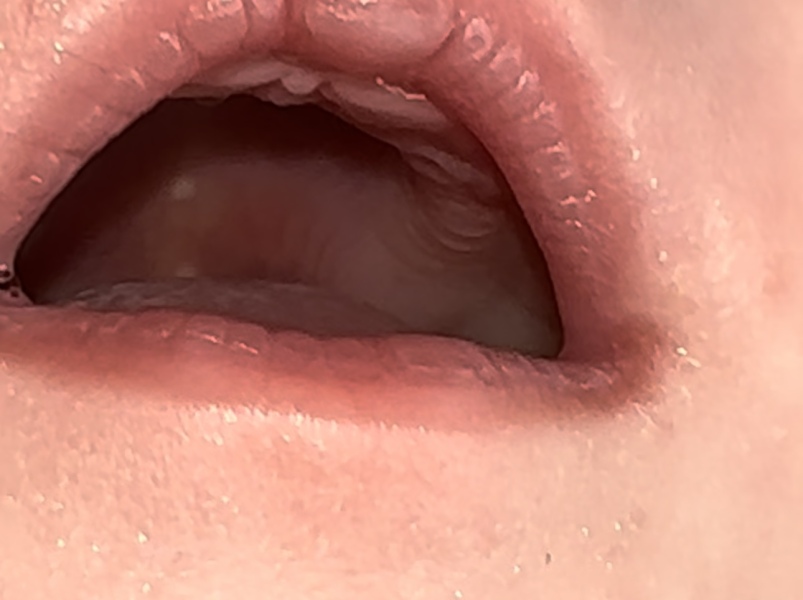 White spots on babies throat