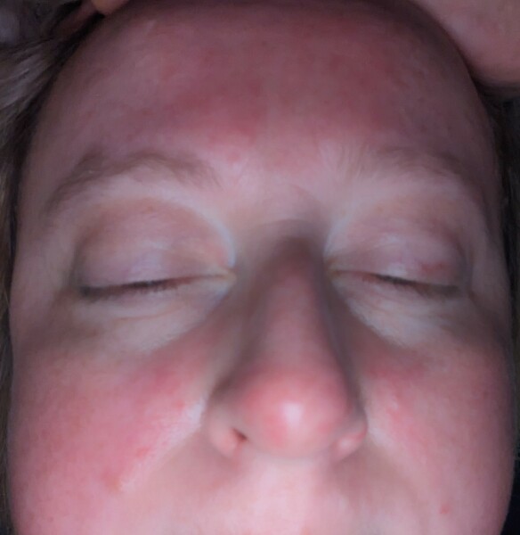 seborrheic dermatitis