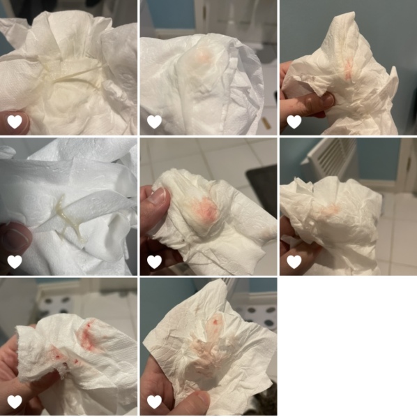 Implantation bleeding? So confused