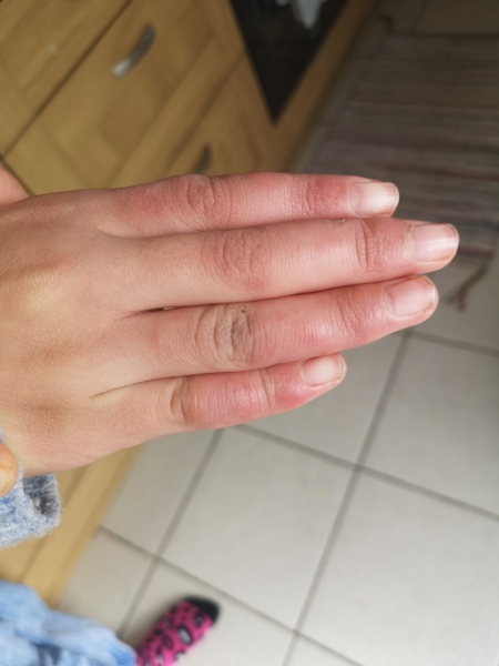 Could my 12yr old daughter have an autoimmune disease? 