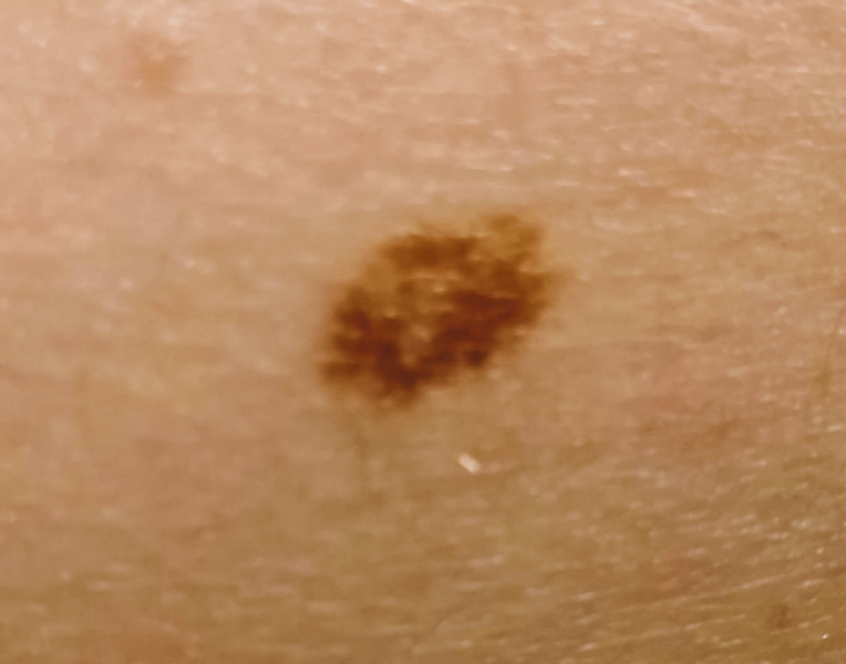 DD mole on leg - asymmetrical and two colours