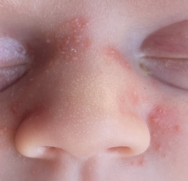 Baby acne?