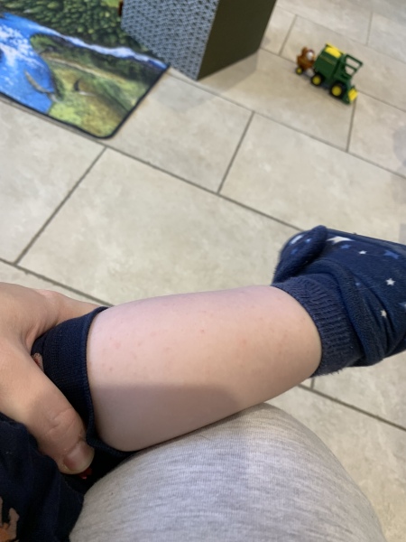 grandson has a rash and I would like opinions please. 