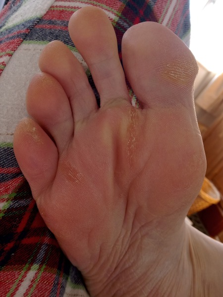 Disgusting Crusty Feet (photos 🤮)
