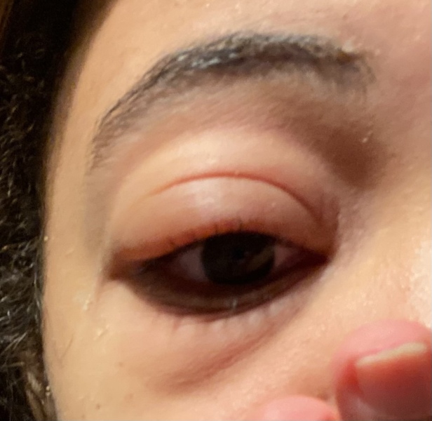 Daughter - Eye infection 
