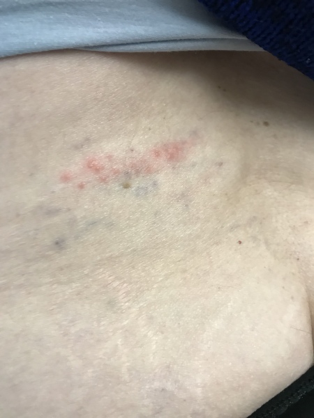 Could this be shingles?