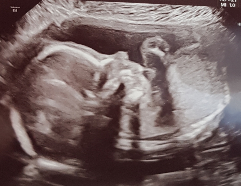 IVF warriors - the journey continues 2