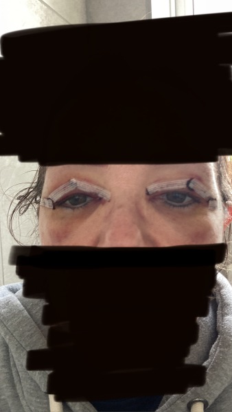 Upper Blepheroplasty