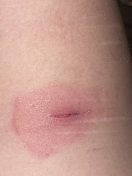 Infected Cyst (with pictures)