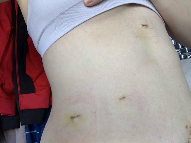 How long to recover from gall bladder surgery ?