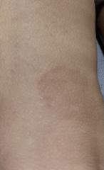 Does my 2 and half year old have ring worm? 