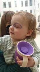 Periorbital cellulitis 