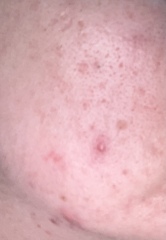 To be at my wits end about my skin!!