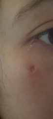 Mole removal 