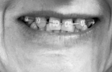 Adult Braces