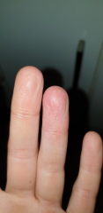 Is this hand Psoriasis?