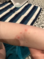 What's this rash?