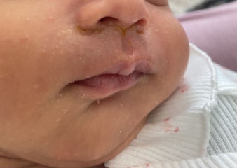 Baby rash