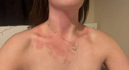 Advice on red skin flare ups please