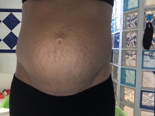 I have a spearated abdomen, also called 'Diastasis Recti'