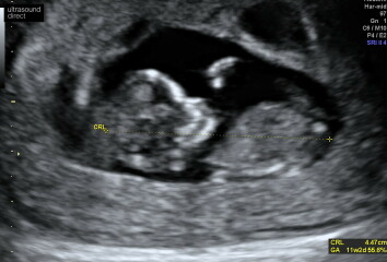 What sex is my baby? Nub Theory 