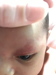 Baby face rash/spots?!
