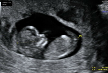 What sex is my baby? Nub Theory 