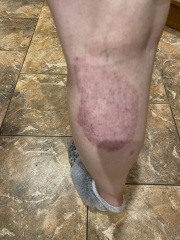 Rash in pregnancy
