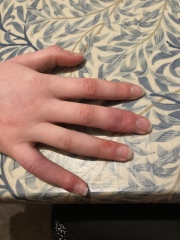 Could my 12yr old daughter have an autoimmune disease? 