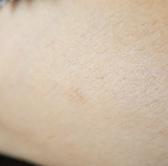 Darker patch on skin 