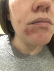 Treatment for spot breakout