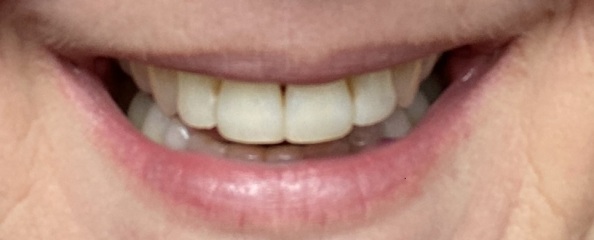 Adult Braces