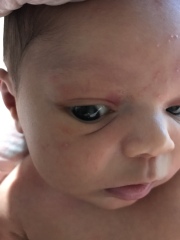 Baby face rash/spots?!