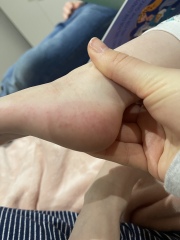 Anyone know what this rash is?