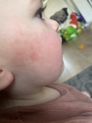 clarithromycin allergy?