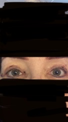 Upper Blepheroplasty