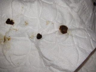 Ears successfully cleared of huge blockage!