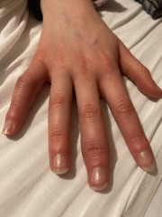 Could my 12yr old daughter have an autoimmune disease? 