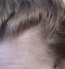 Thinning temples?