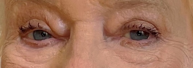 Upper Blepheroplasty