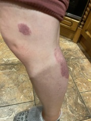 Rash in pregnancy