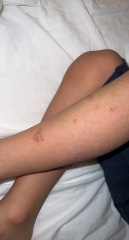 Anyone seen this type of rash before? Pic (Plus recurrent temperature)